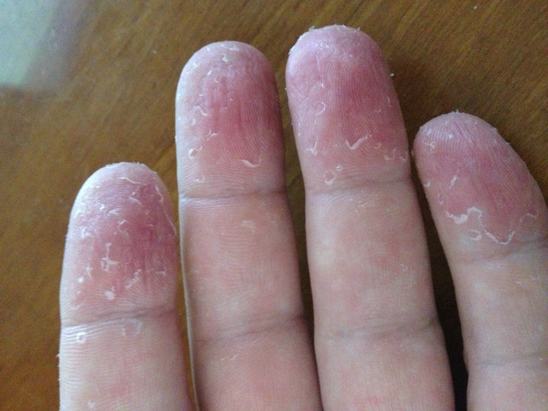 What Causes the Skin to Peel From Fingertips ...