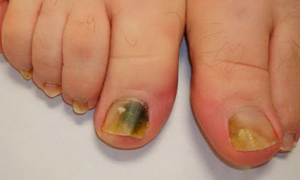 Remedy With 3 Ingredients To Eliminate Toenail Fungus For Lifetime