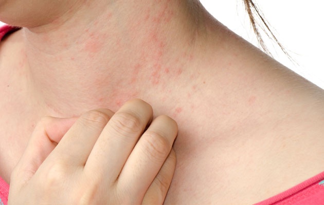 ncredible Home Remedies For Dermatitis