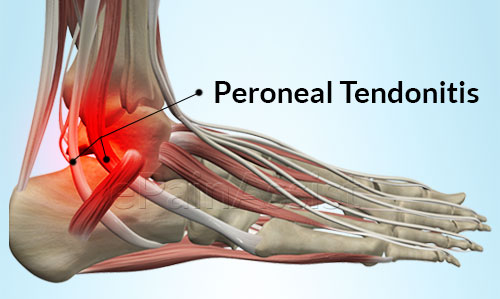 13 Best Home Remedies For Foot Tendonitis