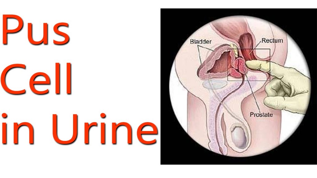 Pus Cell in Urine: Causes, Symptoms, Treatment & Remedies of Pus Cells