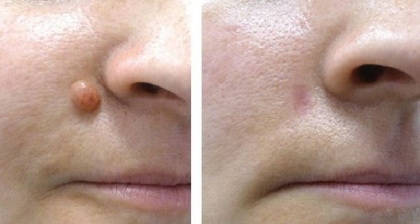 How to Remove Warts by Using This Single Ingredient