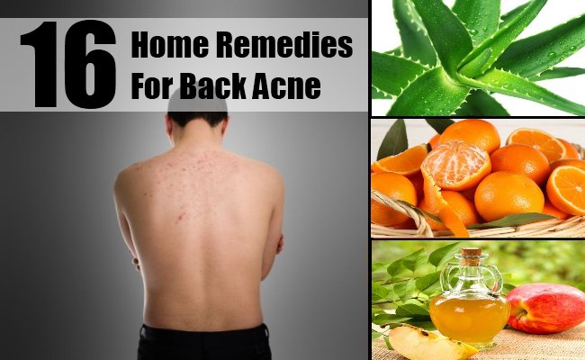 Get Rid of Back Acne with Top 15 Home Remedies