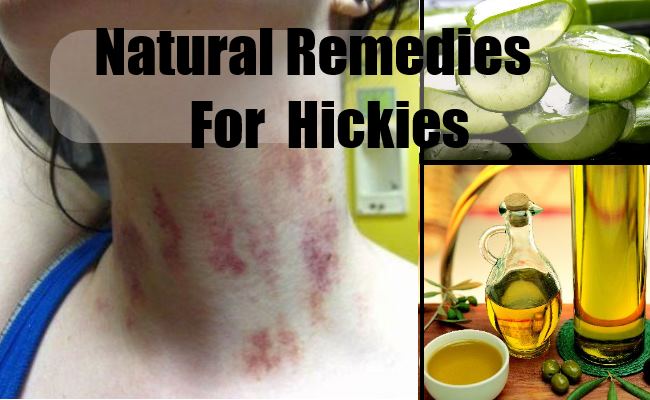 How to Cure Hickeys Fast with Natural Remedies?