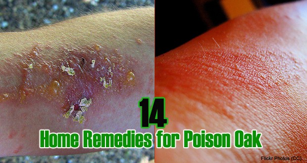 14 Easy and Quick Home Remedies for Poison Oak