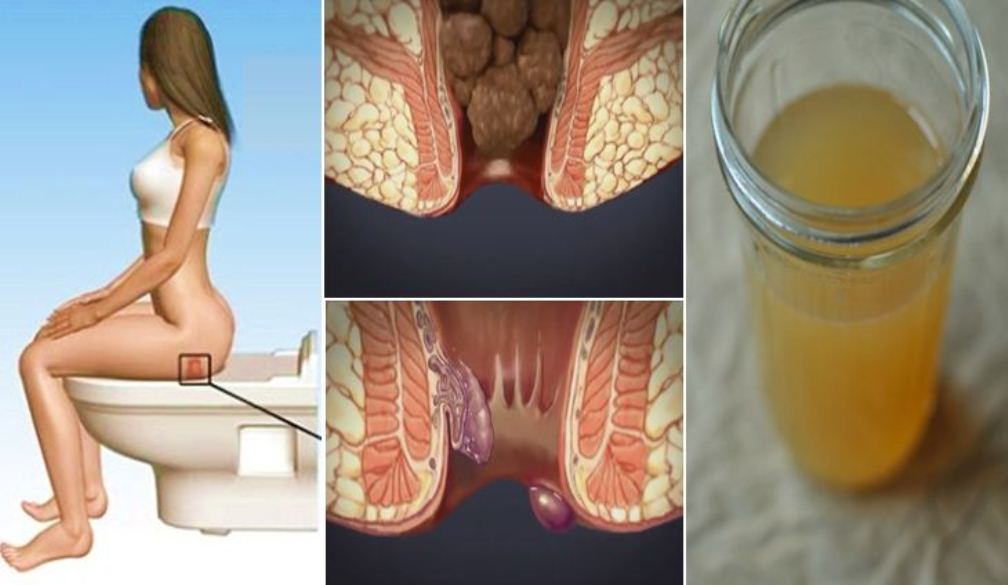 24 Hour 1-Ingredient Hemorrhoid Treatment at Home that Will Shrink Them Super Fast