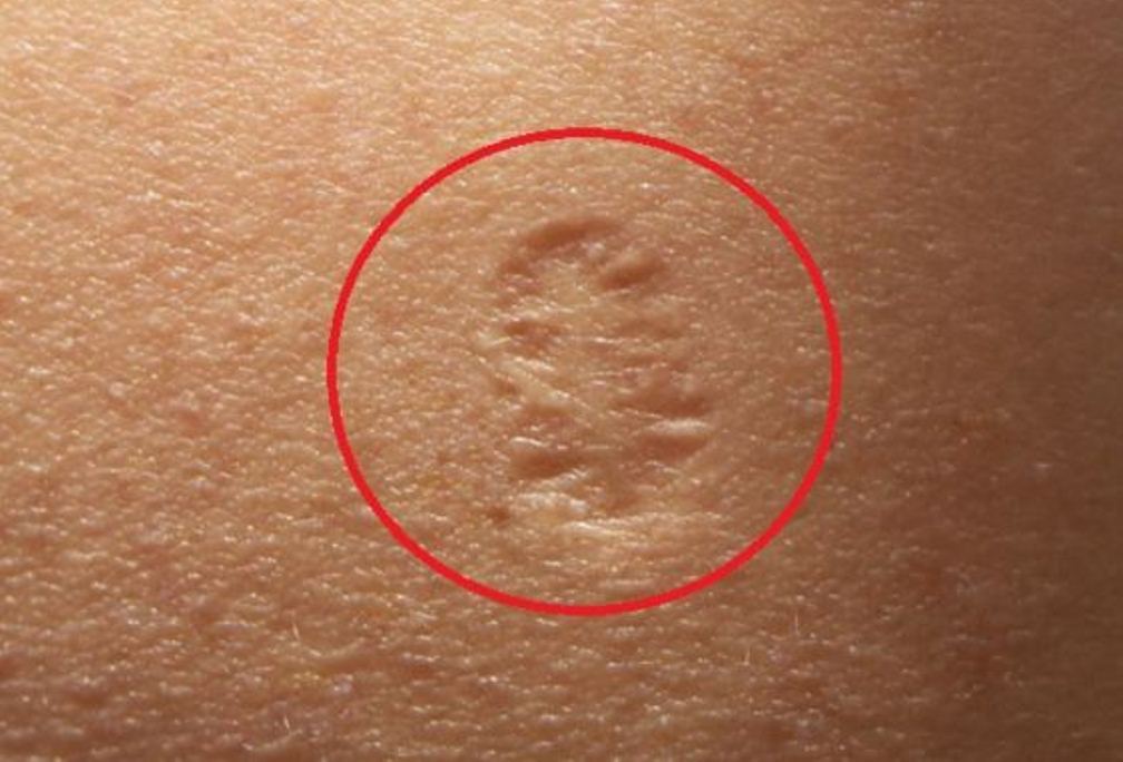 Do You Know the Truth Behind The Small Scar On The Upper Left Arm and Its Real Meaning?