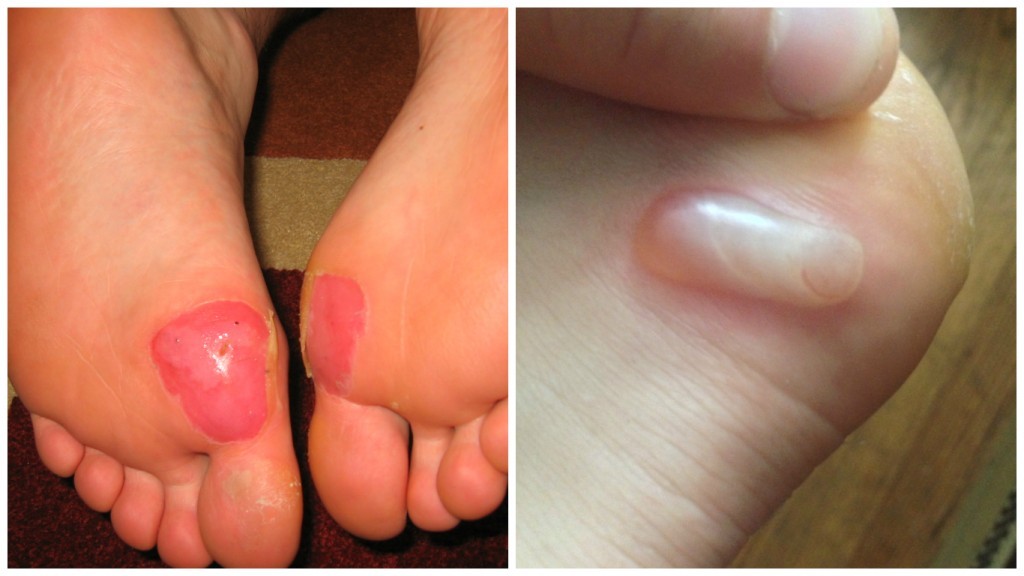 Heal The Blisters On Your Feet With No Medicine!