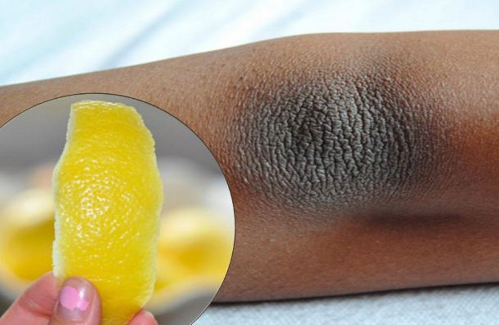 Quick and Easy – Get Rid of Dark Elbows and Knees In a Week