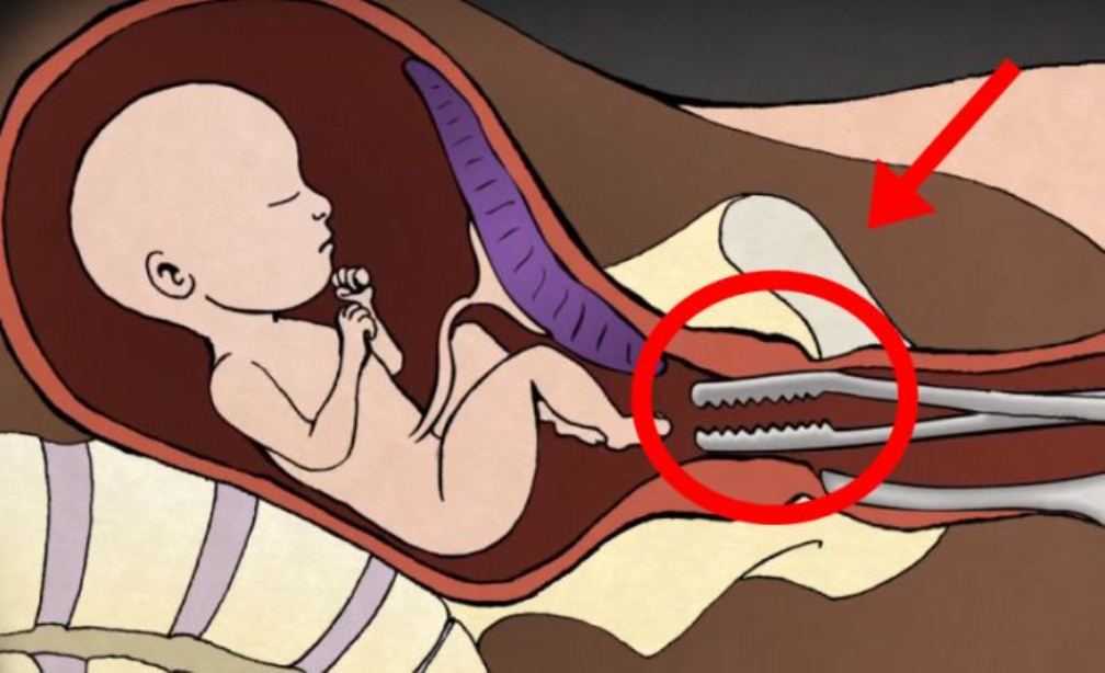 SAY NO TO ABORTION: GYNECOLOGIST REVEALS WHAT HAPPENS TO THE BABY DURING AN ABORTION! (VIDEO)