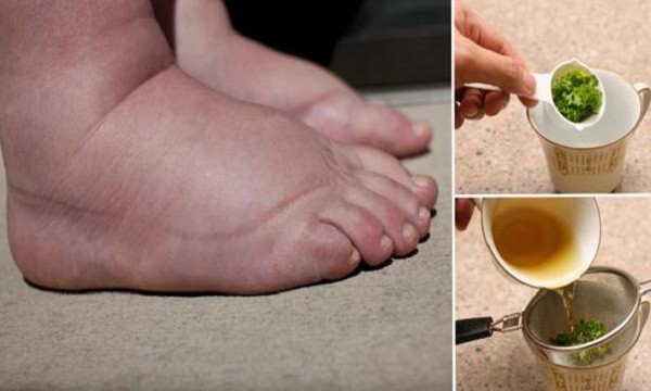 THIS POWERFUL TEA IS THE BEST REMEDY FOR SWOLLEN LEGS