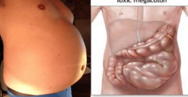 You Are Not Fat! Your Stomach Is Bloated And Here Is How To Get Rid Of It!