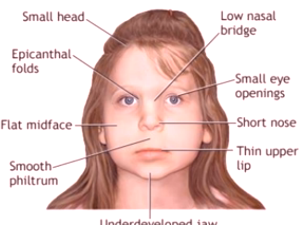 fetal-alcohol-syndrome-facial-features