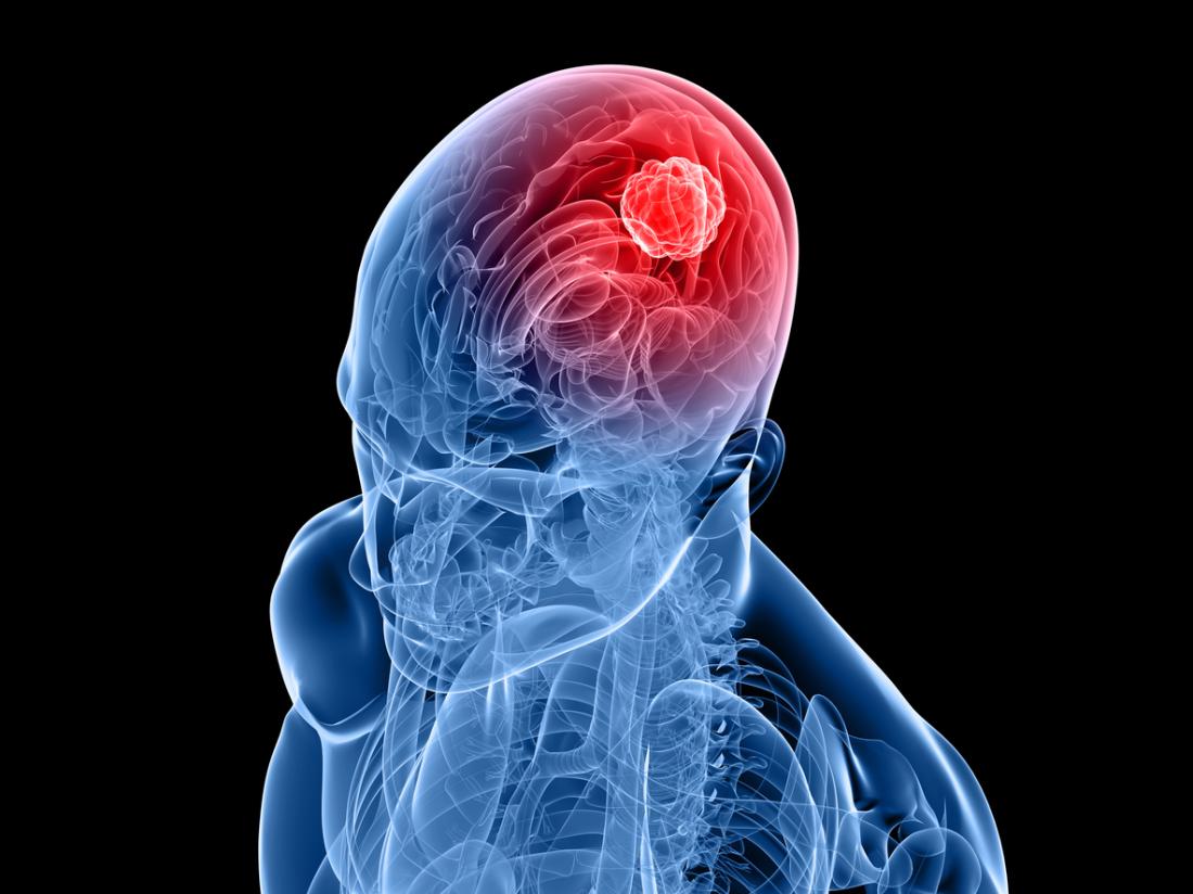 human-brain-with-tumor
